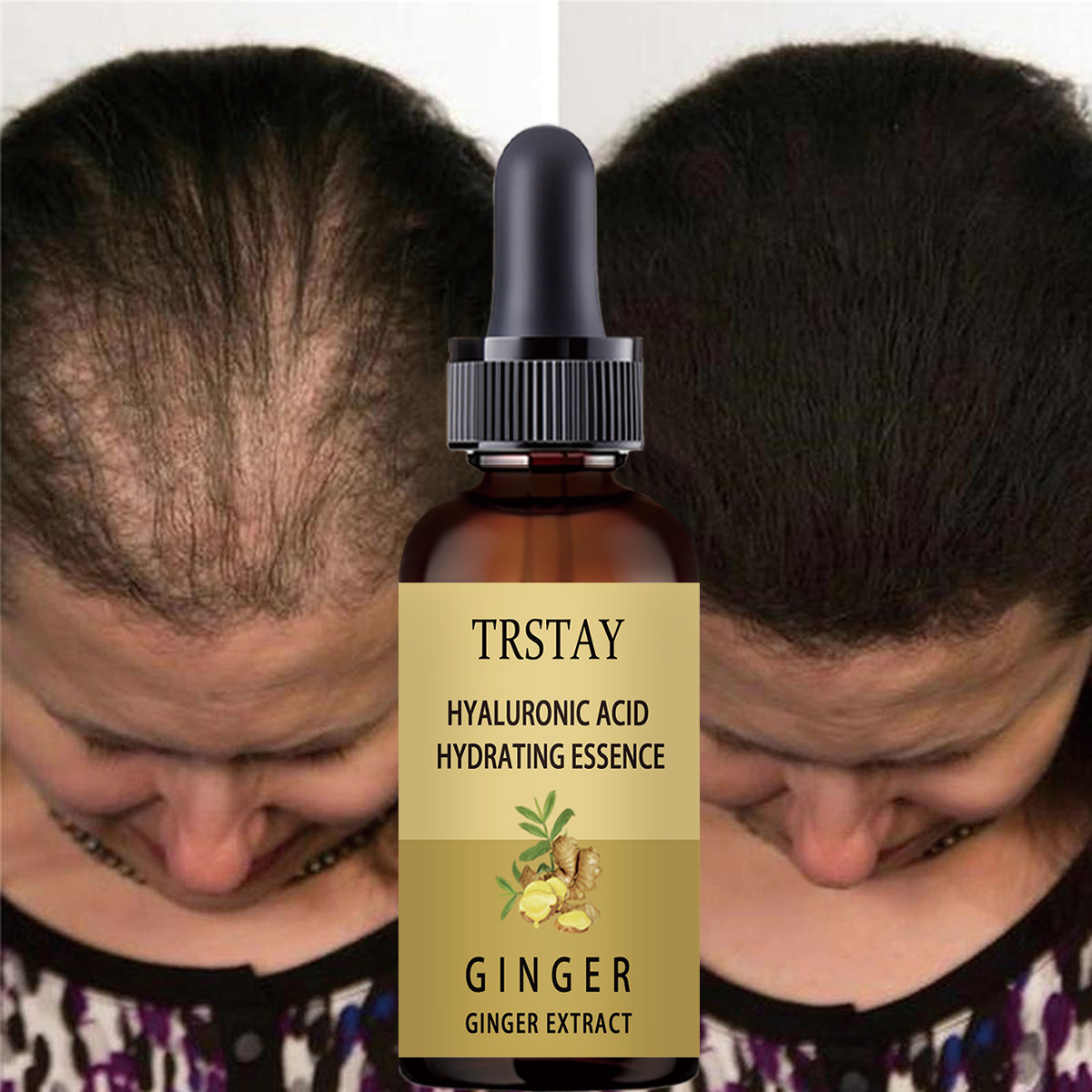 Caffeine Hair Serum - 育毛血清抗脱毛予防脱毛症液体ダメージ毛修復成長が速くなる