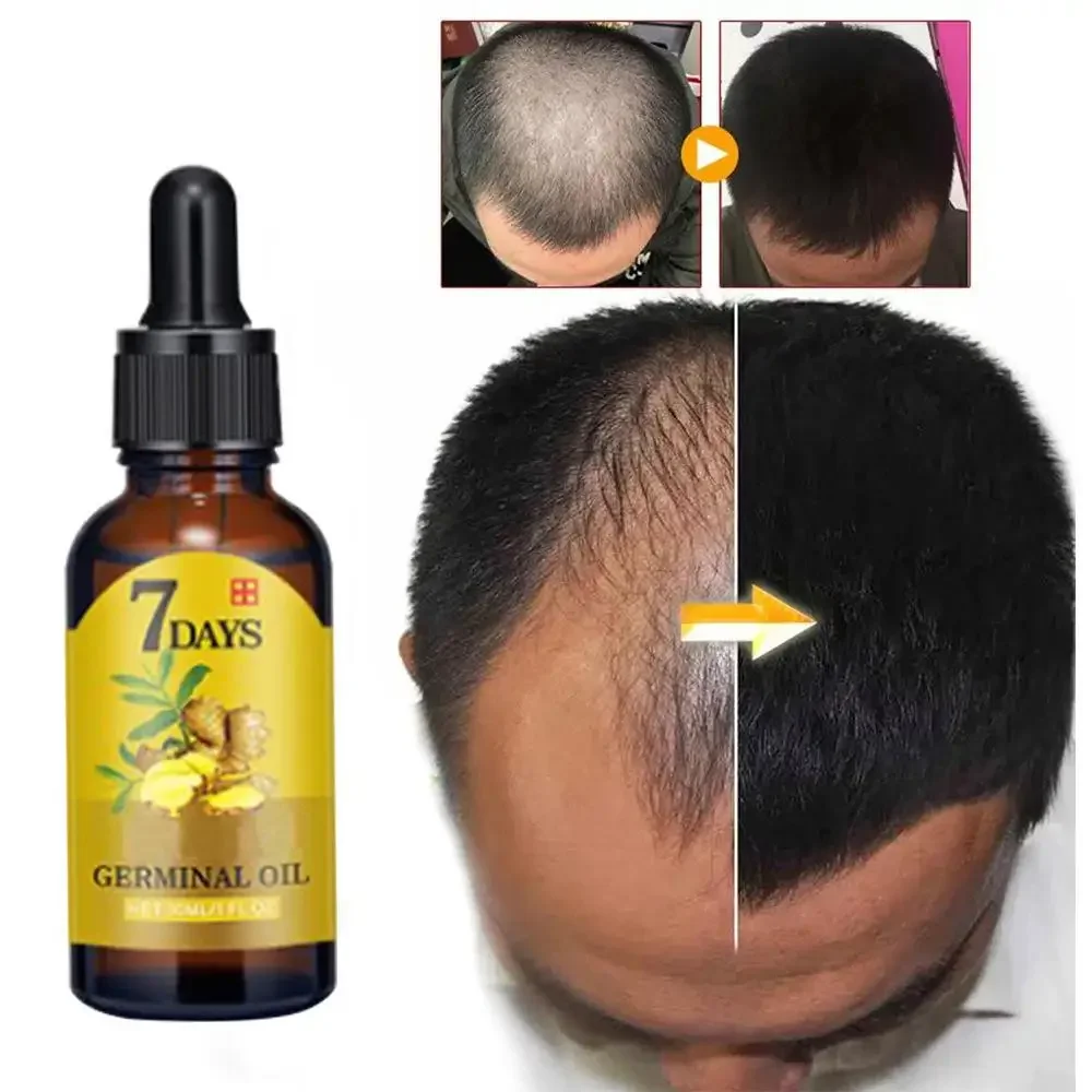 Caffeine Hair Serum - 育毛ジンジャー高速成長髪エッセンシャルオイルヘアケア損失防止オイル頭皮トリートメント男性女性ダメージヘア